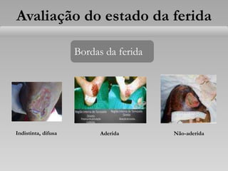 Avaliação do estado da ferida
Bordas da ferida
Indistinta, difusa Aderida Não-aderida
 