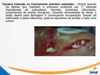 Terceira intenção ou Fechamento primário retardado - Ocorre quando
há fatores que retardam o processo cicatricial por 1ª intenção
(hematomas de subcutâneo, traumas, processos infecciosos,
rompimentos de postos cirúrgicos), havendo necessidade de deixar a
lesão aberta para drenagem e consequente recuperação. Depois de
melhorada a parte infecciosa, pode-se aproximar as bordas e fazer uma
sutura.
 