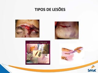TIPOS DE LESÕES
 