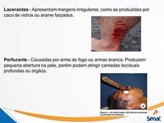 Lacerantes - Apresentam margens irregulares, como as produzidas por
caco de vidros ou arame farpados.
Perfurante - Causadas por arma de fogo ou armas branca. Produzem
pequena abertura na pele, porém podem atingir camadas teciduais
profundas ou órgãos.
 