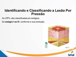 Identificando e Classificando a Lesão Por
Pressão
As LPP’s são classificadas em estágios.
Do estágio I ao IV, conforme a sua evolução.
 