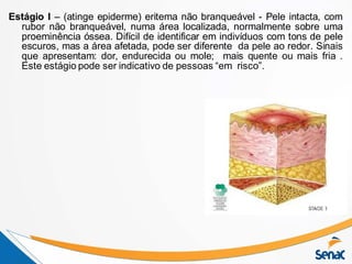 Estágio I – (atinge epiderme) eritema não branqueável - Pele intacta, com
rubor não branqueável, numa área localizada, normalmente sobre uma
proeminência óssea. Difícil de identificar em indivíduos com tons de pele
escuros, mas a área afetada, pode ser diferente da pele ao redor. Sinais
que apresentam: dor, endurecida ou mole; mais quente ou mais fria .
Este estágio pode ser indicativo de pessoas “em risco”.
 