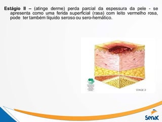 Estágio II – (atinge derme) perda parcial da espessura da pele - se
apresenta como uma ferida superficial (rasa) com leito vermelho rosa,
pode ter também líquido seroso ou sero-hemático.
 