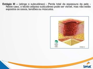 Estágio III – (atinge o subcutâneo) - Perda total da espessura da pele -
Neste caso, o tecido adiposo subcutâneo pode ser visível, mas não estão
expostos os ossos, tendões ou músculos.
 