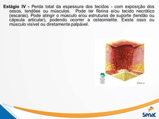 Estágio IV - Perda total da espessura dos tecidos - com exposição dos
ossos, tendões ou músculos. Pode ter fibrina e/ou tecido necrótico
(escaras). Pode atingir o músculo e/ou estruturas de suporte (tendão ou
cápsula articular), podendo ocorrer a osteomielite. Existe osso ou
músculo visível ou diretamente palpável.
 
