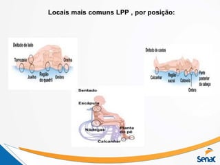Locais mais comuns LPP , por posição:
 