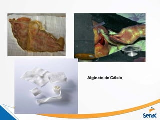 Alginato de Cálcio
 