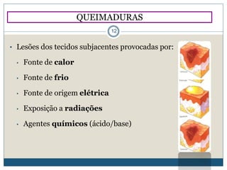 QUEIMADURAS
12
• Lesões dos tecidos subjacentes provocadas por:
• Fonte de calor
• Fonte de frio
• Fonte de origem elétrica
• Exposição a radiações
• Agentes químicos (ácido/base)
 