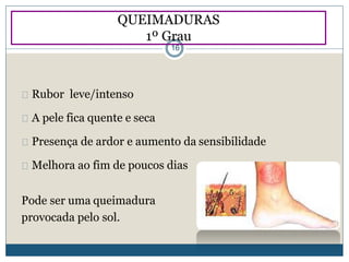 Rubor leve/intenso
A pele fica quente e seca
Presença de ardor e aumento da sensibilidade
Melhora ao fim de poucos dias
Pode ser uma queimadura
provocada pelo sol.
QUEIMADURAS
1º Grau
16
 
