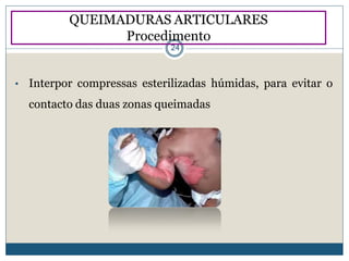• Interpor compressas esterilizadas húmidas, para evitar o
contacto das duas zonas queimadas
QUEIMADURAS ARTICULARES
Procedimento
24
 