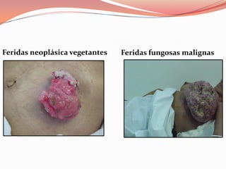 Feridas fungosas malignasFeridas neoplásica vegetantes
 