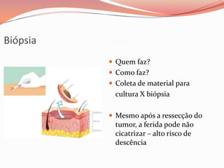 Biópsia
 Quem faz?
 Como faz?
 Coleta de material para
cultura X biópsia
 Mesmo após a ressecção do
tumor, a ferida pode não
cicatrizar – alto risco de
descência
 