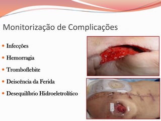 Monitorização de Complicações
 Infecções
 Hemorragia
 Tromboflebite
 Deiscência da Ferida
 Desequilíbrio Hidroeletrolítico
 