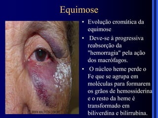 Equimose
• Evolução cromática da
equimose
• Deve-se à progressiva
reabsorção da
"hemorragia" pela ação
dos macrófagos.
• O núcleo heme perde o
Fe que se agrupa em
moléculas para formarem
os grãos de hemossiderina
e o resto da heme é
transformado em
biliverdina e bilirrubina.
 