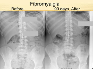 Before 90 days After
Fibromyalgia
 