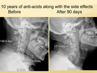 10 years of anti-acids along with the side effects
Before After 90 days
 