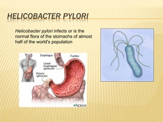 Helicobacter pylori infects or is the
normal flora of the stomachs of almost
half of the world's population
 