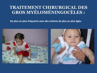   TRAITEMENT CHIRURGICAL DES GROS MYÉLOMÉNINGOCÈLES : De plus en plus fréquents avec des enfants de plus en plus âgés. 