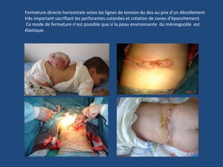 Fermeture directe horizontale selon les lignes de tension du dos au prix d’un décollement très important sacrifiant les perforantes cutanées et création de zones d’épanchement. Ce mode de fermeture n’est possible que si la peau environnante  du méningocèle  est  élastique.  