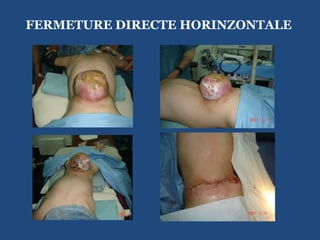 FERMETURE DIRECTE HORINZONTALE 