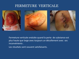 Fermeture verticale ondulée quand la perte  de substance est plus haute que large avec toujours un décollement avec  ses inconvénients . Les résultats sont souvent satisfaisants. FERMETURE  VERTICALE 