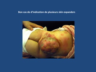 Bon cas de d’indication de plusieurs skin expanders 