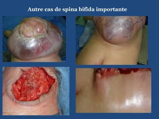 Autre cas de spina bifida importante  