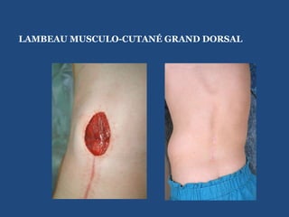 LAMBEAU MUSCULO-CUTANÉ GRAND DORSAL 