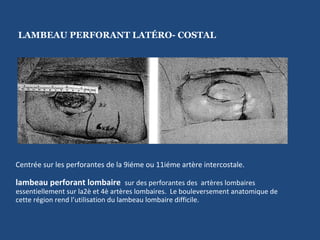 lambeau perforant lombaire  sur des perforantes des  artères lombaires essentiellement sur la2è et 4è artères lombaires.  Le bouleversement anatomique de cette région rend l’utilisation du lambeau lombaire difficile. LAMBEAU PERFORANT LATÉRO- COSTAL Centrée sur les perforantes de la 9iéme ou 11iéme artère intercostale.  