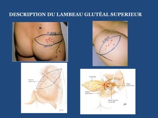  DESCRIPTION DU LAMBEAU GLUTÉAL SUPERIEUR    