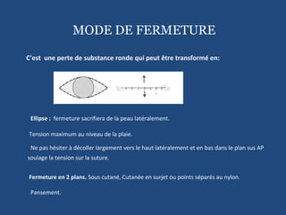 Ellipse :  fermeture sacrifiera de la peau latéralement. Tension maximum au niveau de la plaie. Ne pas hésiter à décoller largement vers le haut latéralement et en bas dans le plan sus AP soulage la tension sur la suture. Fermeture en 2 plans.  Sous cutané, Cutanée en surjet ou points séparés au nylon. Pansement. C’est  une perte de substance ronde qui peut être transformé en: MODE DE FERMETURE 