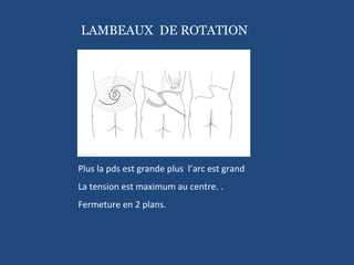 Plus la pds est grande plus  l’arc est grand La tension est maximum au centre. . Fermeture en 2 plans. LAMBEAUX  DE ROTATION 