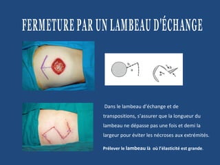 Dans le lambeau d’échange et de transpositions, s’assurer que la longueur du lambeau ne dépasse pas une fois et demi la largeur pour éviter les nécroses aux extrémités. Prélever le  lambeau  là  où l’élasticité est grande . FERMETURE PAR UN LAMBEAU D'ÉCHANGE 