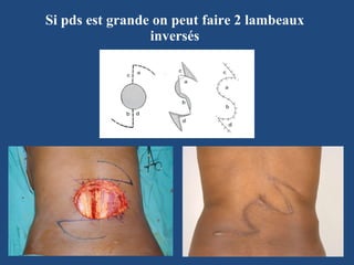 Si pds est grande on peut faire 2 lambeaux inversés 