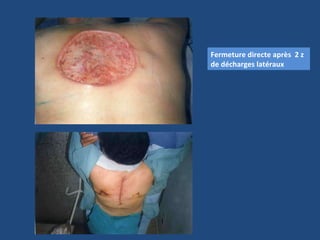 Fermeture directe après  2 z de décharges latéraux 