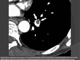 Positive Pe Study Imaging of pulmonary embolism | PDF