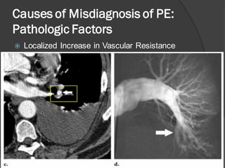 Positive Pe Study Imaging of pulmonary embolism | PDF
