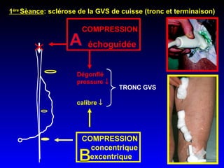 X COMPRESSION  échoguidée   COMPRESSION concentrique excentrique  TRONC GVS Dégonflé pressure   calibre   1 ère  Sèance : sclérose de la GVS de cuisse (tronc et terminaison) 