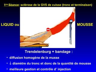 1 ère  Sèance : sclérose de la GVS de cuisse (tronc et terminaison) Trendelenburg + bandage : diffusion homogène de la musse     diamètre du tronc et donc de la quantité de mousse  meilleure gestion et contrôle d’ injection LIQUID ou MOUSSE 