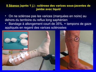 II Séance  (après 1 j.) : sclérose des varices sous-jacentes de jambe avec liquid On ne sclérose pas les varices (marquées en noire) au dehors du territoire du reflux long saphénien Bandage à allongement court de 35%, + tampons de gaze appliqués en regard des varices sclérosées 