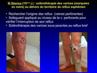 III Séance  (15 ème  j.) : sclérothérapie des varices (marquées en noire) au dehors du territoire du reflux saphénien Rechercher l’origine des reflux  (veines perforantes)  Safeguard appliqué au niveau de la v. perforante pour vérifier l’interruption de son reflux Sclérothérapie des varices sous-jacentes au reflux bref 