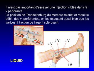 Il n’est pas important d’essayer une injection ciblée dans la v perforante La position en Trendelenburg du membre ralentit et réduit le débit  des v. perforantes, en les exposant aussi bien que les varices à l’action de l’agent sclérosant LIQUID  