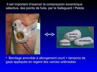 Il est important d’exercer la compression excentrique sélective, des points de fuite, par le Safeguard / Pelote Bandage amovible à allongement court + tampons de gaze appliqués en regard des varices sclérosées  Dodd et Hunter   retrotibiales musculaires 