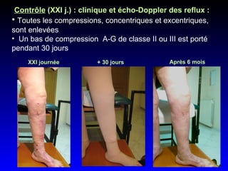 Contrôle  (XXI j.) : clinique et écho-Doppler des reflux :   Toutes les compressions, concentriques et excentriques, sont enlevées  Un bas de compression  A-G de classe II ou III est porté  pendant 30 jours XXI journée + 30 jours Après 6 mois  