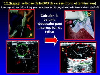 interruption du reflux long par compression échoguidée de la terminaison de GVS  A b a 1 ère  Sèance : sclérose de la GVS de cuisse (tronc et terminaison) Calculer  le volume nécessaire pour l’interruption du reflux B 