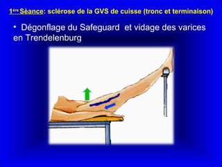 Dégonflage du Safeguard  et vidage des varices en Trendelenburg 1 ère  Sèance : sclérose de la GVS de cuisse (tronc et terminaison) 