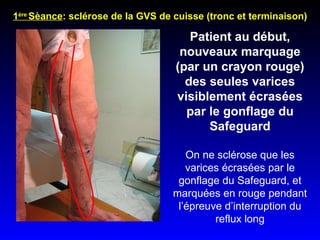 Patient au début, nouveaux marquage (par un crayon rouge) des seules varices visiblement écrasées par le gonflage du Safeguard On ne sclérose que les varices écrasées par le gonflage du Safeguard, et marquées en rouge pendant l’épreuve d’interruption du reflux long 1 ère  Sèance : sclérose de la GVS de cuisse (tronc et terminaison) 