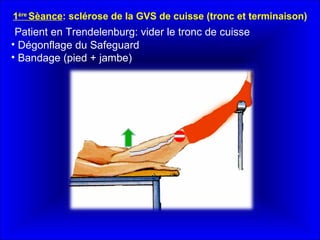 Patient en Trendelenburg: vider le tronc de cuisse  Dégonflage du Safeguard  Bandage (pied + jambe)   1 ère  Sèance : sclérose de la GVS de cuisse (tronc et terminaison) 