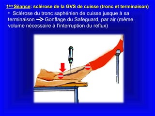 Sclérose du tronc saphénien de cuisse jusque à sa terminaison  Gonflage du Safeguard, par air (même volume nécessaire à l’interruption du reflux) 1 ère  Sèance : sclérose de la GVS de cuisse (tronc et terminaison) 