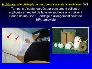 1 ère  Sèance : sclérothérapie du tronc de cuisse et de la terminaison GVS Tampons d’ouate, gardés par pansement collant et appliqués en regard de la veine saphène à la cuisse + Bande de mousse + Bandage à allongement court de 35%, amovible 